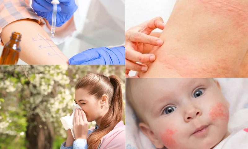 Alerjik Hastalıklar: Modern Dünyanın Yaygın Sorunu