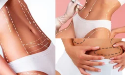Vaser Liposuction ile Bölgesel Dirençli Yağlara Kalıcı Olarak Veda Etmek