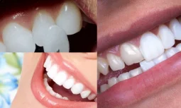 Diş Laminası Yapımı Nedir?