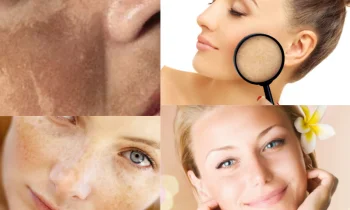 Melasma Tedavisi Fiyatları Ne Kadar?