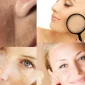 Melasma Tedavisi Fiyatları Ne Kadar?