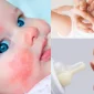 Süt Ürünlerine Alerji Nedir?